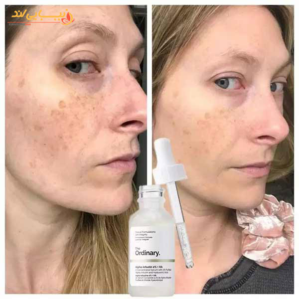 سرم ضد لک آلفا آربوتین 2% اوردینری The Ordinary